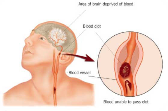 Blod clot
