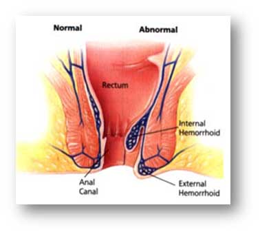 Hemorrhoids