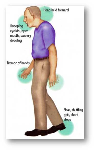 Parkinson's symptoms